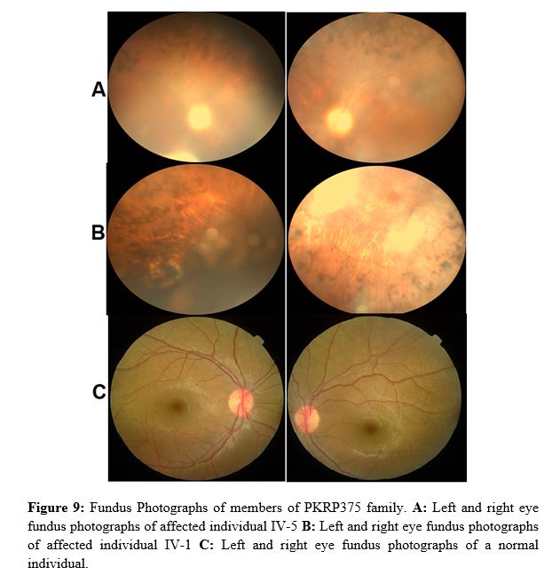 Fundoscopy